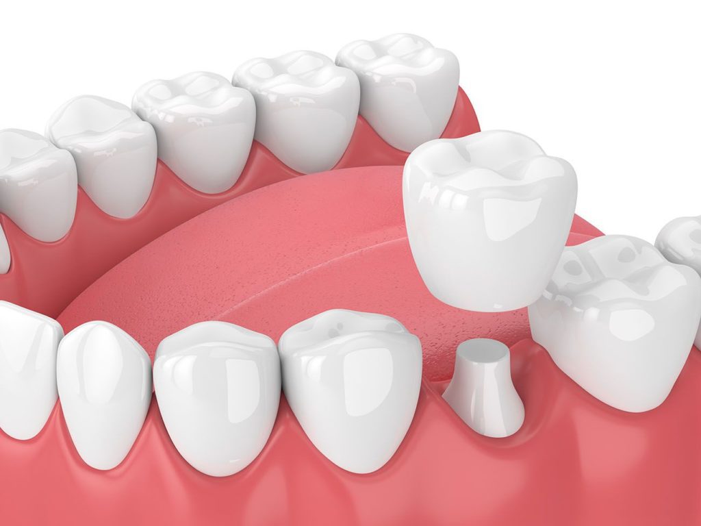 dental crown benefits Midland Texas