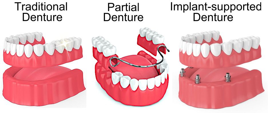 Temporary Dentures vs. Permanent Dentures - Pickett Family Dental